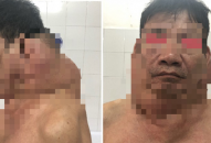 "Người gấu" được phẫu thuật thành công khối u khổng lồ