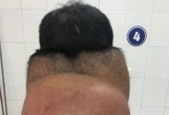 Phẫu thuật thành công những khối u khổng lồ cho “người gấu”