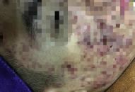 Một phụ nữ bị "cày nát" da mặt sau lăn kim làm đẹp