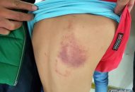 Đình chỉ dạy 1 tháng đối với cô giáo đánh học sinh lớp 2 bầm lưng