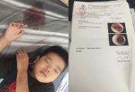 Vụ cô giáo đánh học sinh vì làm bài chậm: Học sinh nhập viện điều trị