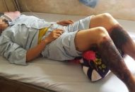 Lội mương bắt cua, người phụ nữ bỏng rộp chân vì… axít đổ trộm