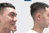 Cắt hàm giúp chàng trai nhiều năm không nhai được