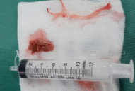 Suýt thiệt mạng do miếng thịt bò mắc kẹt trong thực quản