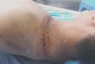 Nhóm thanh niên chém nhau toạc vai, nghi nổ súng khi xô xát