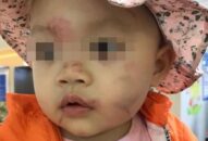 Hải Phòng: Cháu bé 14 tháng tuổi bị bầm tím mặt sau ngày đầu đi học