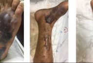 Ăn hải sản sống, người đàn ông ở Hải Phòng tử vong