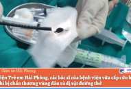 Bệnh viện Trẻ em Hải Phòng: Cấp cứu kịp thời bệnh nhi bị chấn thương vùng đầu và dị vật đường thở