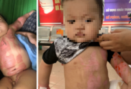 Cảnh báo mối lo ngại chữa bỏng bằng thuốc nam trên cơ thể trẻ nhỏ