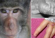 Nóng: Bộ Y tế ban hành hướng dẫn chẩn đoán, điều trị và phòng bệnh đậu mùa khỉ ở người