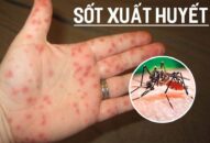 Tình hình dịch sốt xuất huyết phức tạp, Thủ tướng Chính phủ ban hành công điện tăng cường phòng, chống