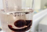 Bệnh viện Đa khoa Quốc tế Hải Phòng: Gắp thành công con vắt rừng sống trong mũi người bệnh