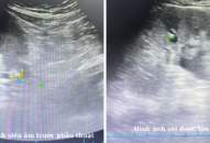 Bệnh viện đa khoa Quốc tế Hải Phòng: Tán sỏi niệu quản thành công cho nhiều thai phụ