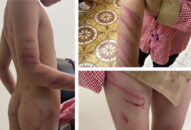 Cháu bé lớp 2 bị bố dượng đánh thâm tím mặt