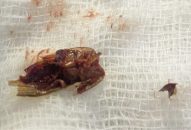 Tổn thương tai nghiêm trọng sau khi tự ý gắp dị vật trong tai