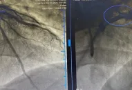 Nhồi máu cơ tim cấp, nguy cơ tử vong cao nếu không được phát hiện, chẩn đoán và cấp cứu kịp thời