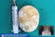 Giúp người bệnh thoát sỏi bàng quang khổng lồ