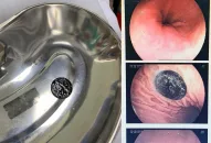 Cảnh báo tai nạn nuốt dị vật của trẻ em