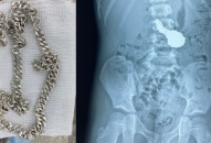 Bệnh viện Quốc tế Sản nhi Hải Phòng kịp thời gắp dây truyền bạc trong ổ bụng của bệnh nhi 6 tuổi