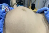 Bệnh viện Trẻ em Hải Phòng: Phẫu thuật thành công cắt bỏ khối u buồng trứng nặng hơn 6kg cho bé gái 9 tuổi