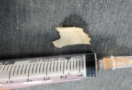 Kịp thời xử lý, gắp mảnh xương lớn chắn ngang thực quản cổ người bệnh