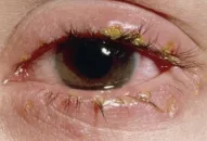 Chủ động phòng, chống bệnh đau mắt đỏ