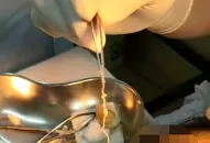 Giun dài 10cm sống trong mắt người phụ nữ