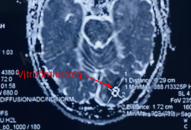 Nam thanh niên Hải Phòng bị đột quỵ não sau khi tắm