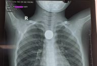 Bệnh viện Trẻ em Hải Phòng gắp thành công đồng xu kích thước gần 3cm ra khỏi thực quản