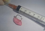 Bệnh viện Trẻ em Hải Phòng cấp cứu thành công trường hợp bệnh nhi nuốt phải dụng cụ trong quá trình chỉnh nha